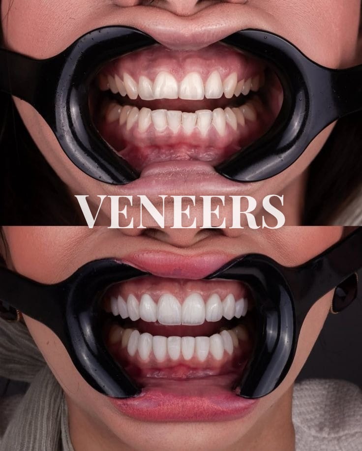 veneers