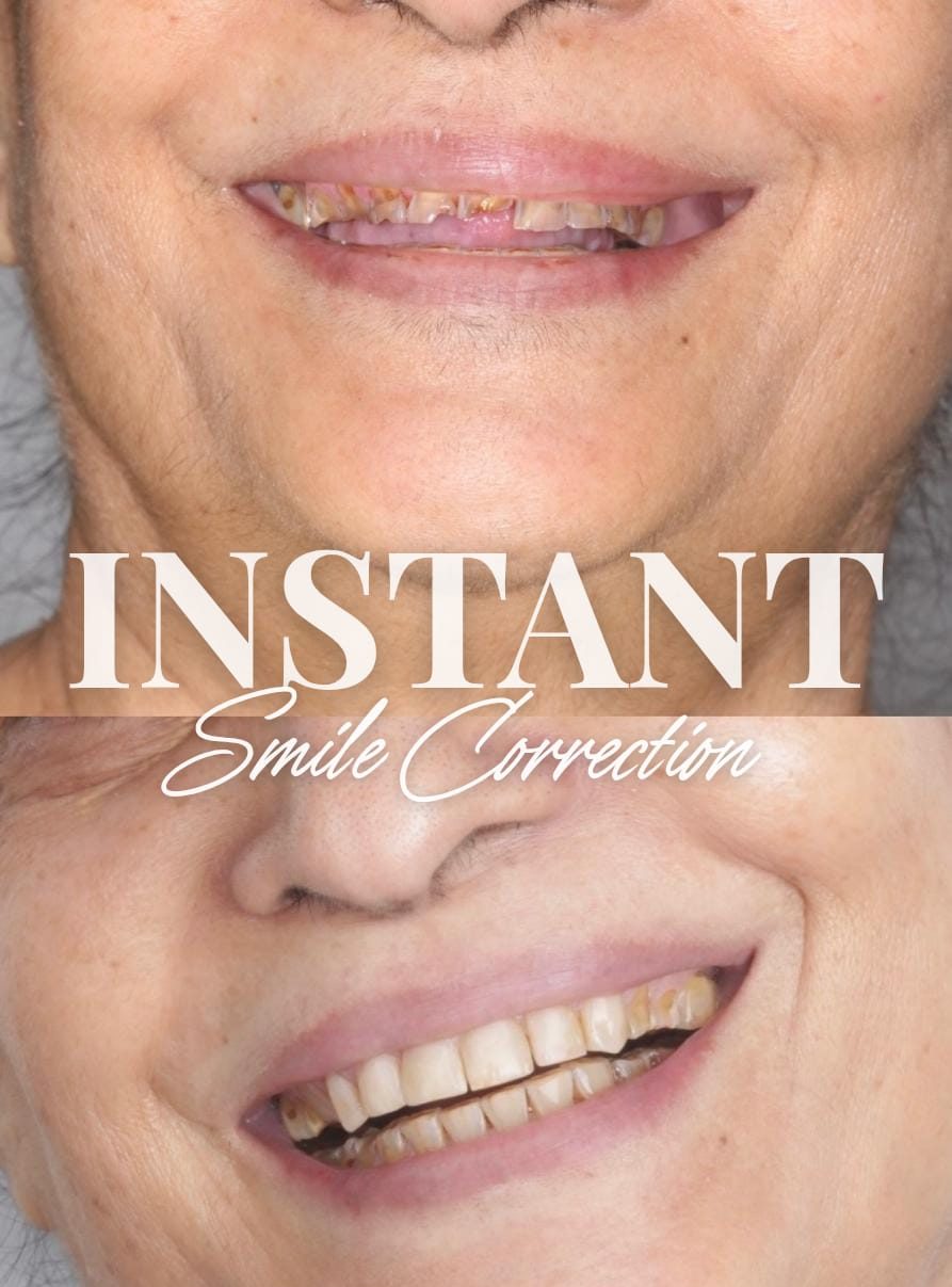 smile correction